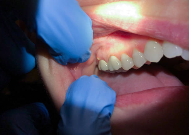 Best Emergency Dental Care for Broken or Chipped Teeth in Nokesville, VA